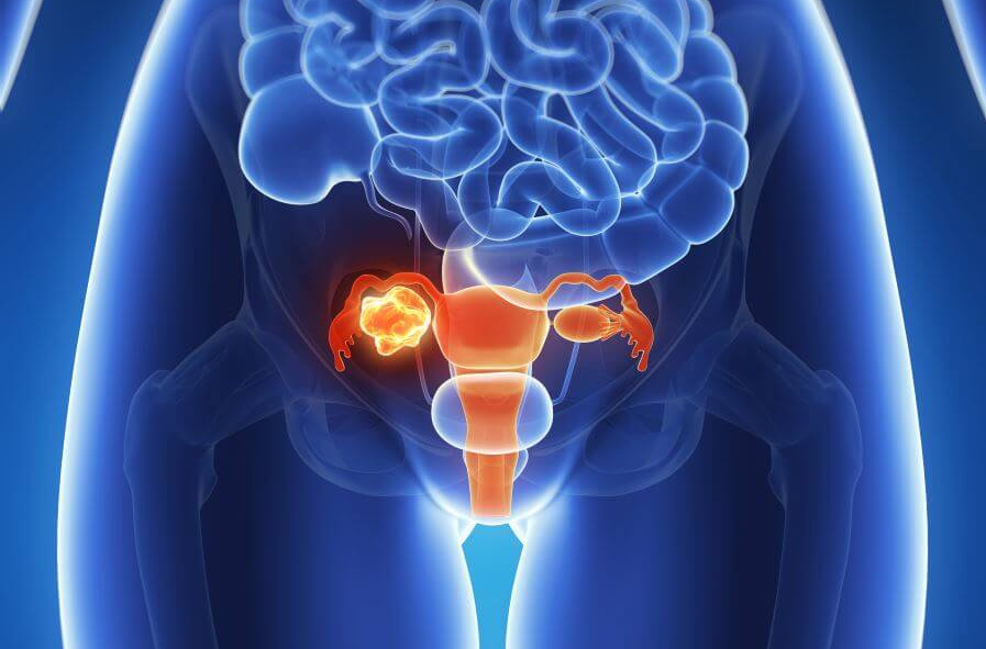 Miomas Uterinos: Qué Son, Causas y Tratamientos Naturales